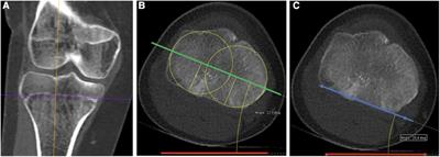 A new method for assessing tibial torsion using <mark class="highlighted">computerized tomography</mark> in a pediatric population